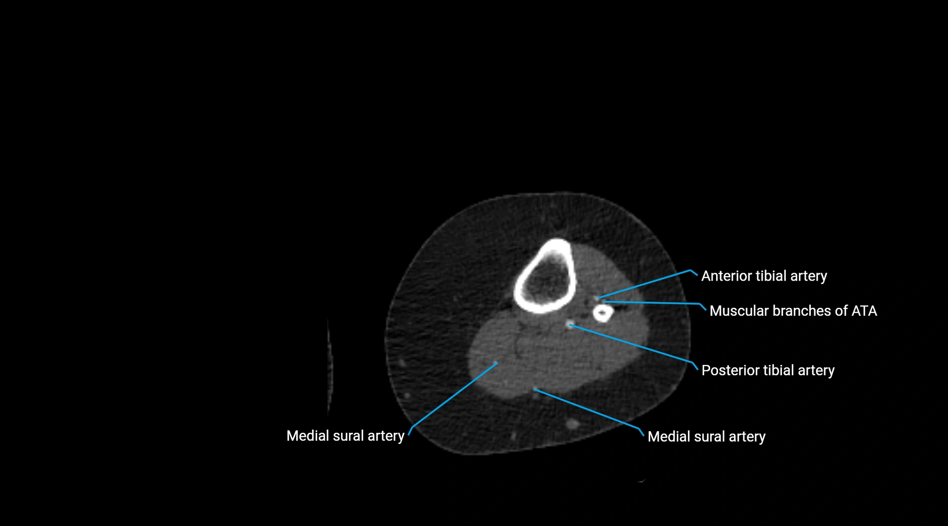 CTA lower limb cross sectional anatomy labelled image _191.webp